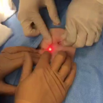 laser pilonidal cyst removal near me