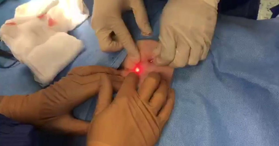 laser pilonidal cyst removal near me