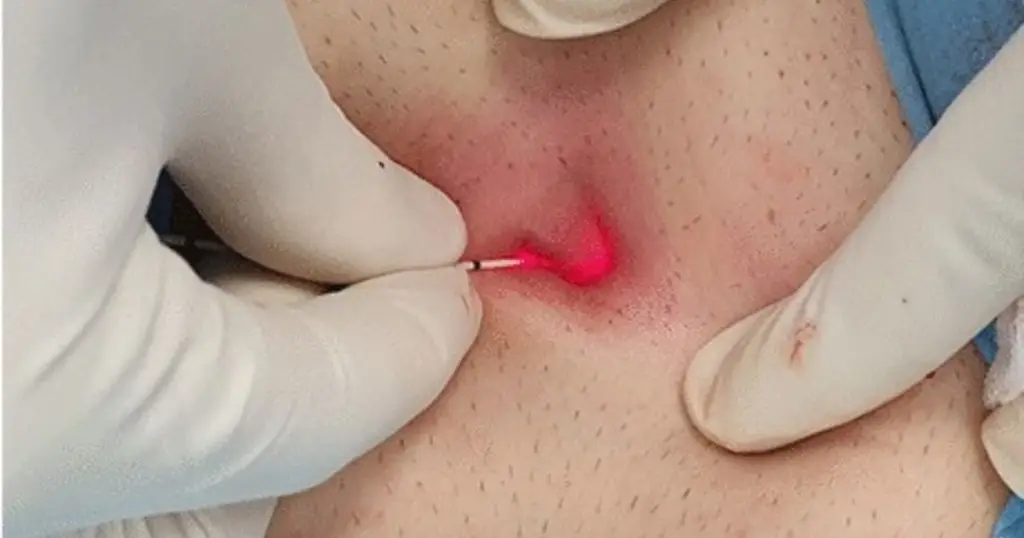 laser pilonidal cyst removal near me