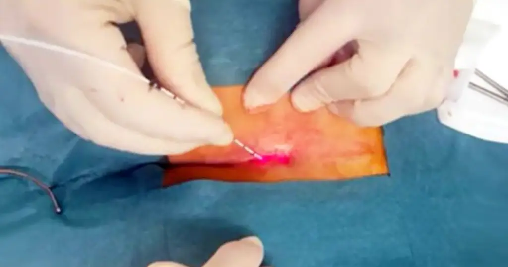 laser pilonidal cyst removal near me