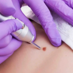 genital wart treatment near me