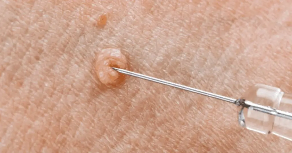 genital wart treatment near me 