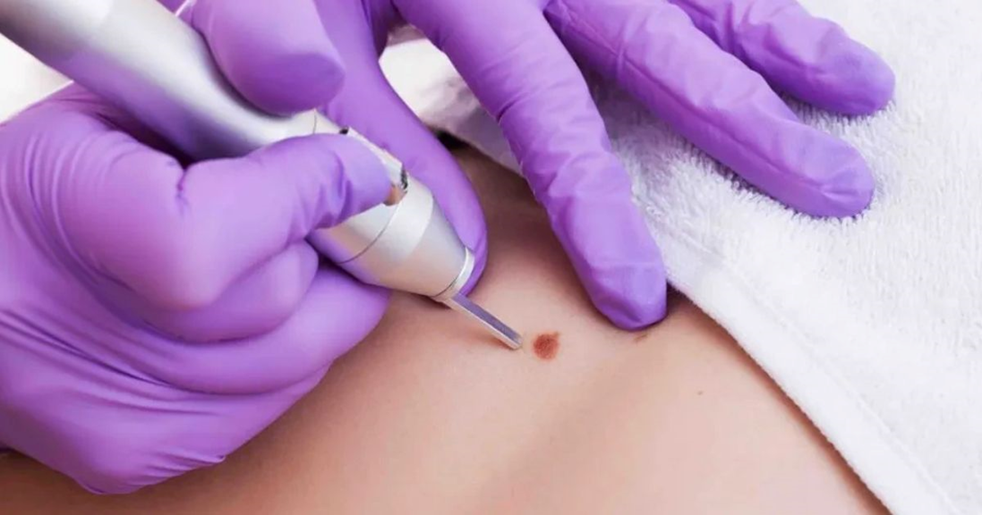 genital wart treatment near me